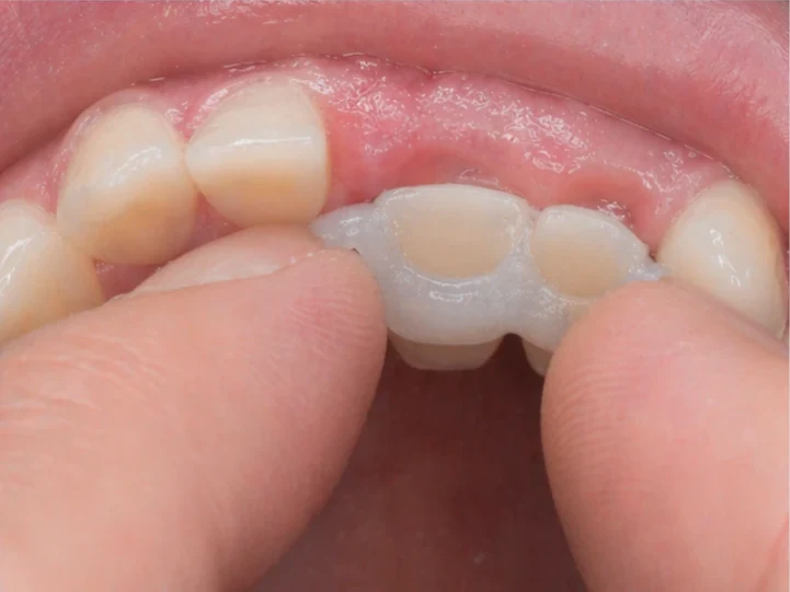 Bildverlauf Denticor – Schritt 7: provisorische Versorgung – oberer mittlerer und seitlicher Schneidezahn