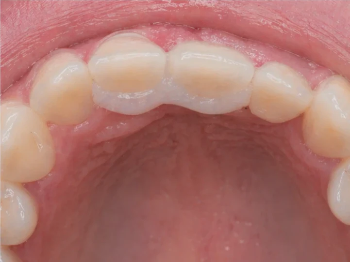 Bildverlauf Denticor – Schritt 8: provisorische Versorgung – oberer mittlerer und seitlicher Schneidezahn