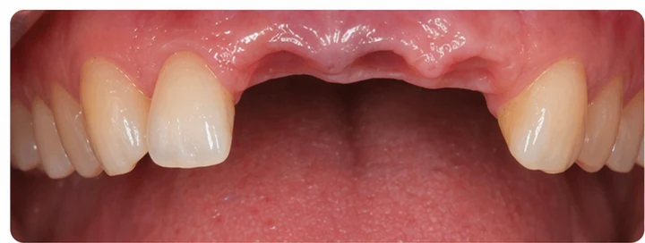 Bildverlauf Denticor – Schritt 1: provisorische Versorgung – oberer mittlerer, seitlicher Schneidezahn und Eckzahn