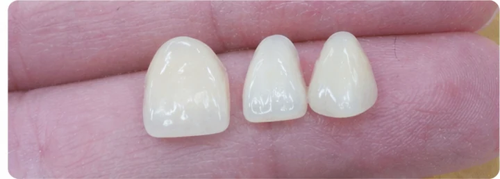 Bildverlauf Denticor – Schritt 3: provisorische Versorgung – oberer mittlerer, seitlicher Schneidezahn und Eckzahn