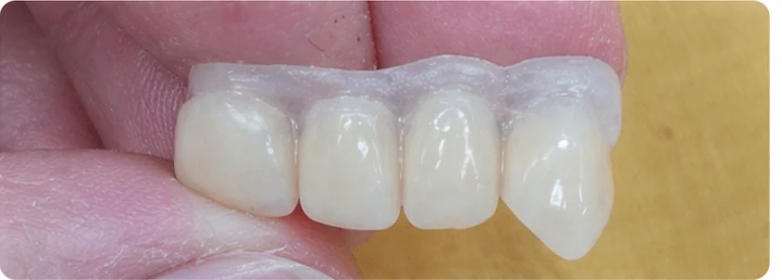 Bildverlauf Denticor – Schritt 4: provisorische Versorgung – oberer mittlerer, seitlicher Schneidezahn und Eckzahn