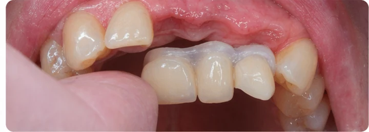 Bildverlauf Denticor – Schritt 5: provisorische Versorgung – oberer mittlerer, seitlicher Schneidezahn und Eckzahn