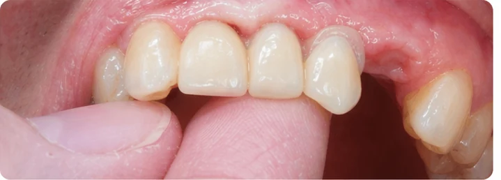 Bildverlauf Denticor – Schritt 6: provisorische Versorgung – oberer mittlerer, seitlicher Schneidezahn und Eckzahn