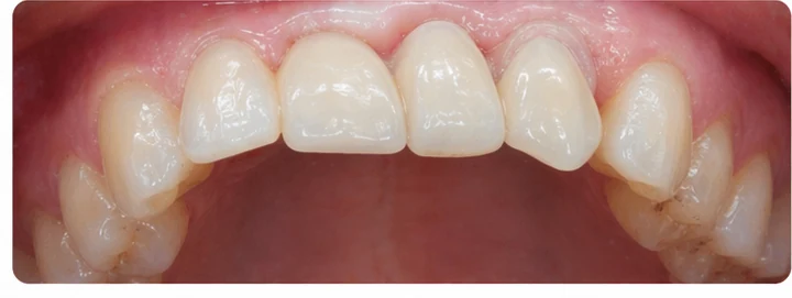 Bildverlauf Denticor – Schritt 7: provisorische Versorgung – oberer mittlerer, seitlicher Schneidezahn und Eckzahn