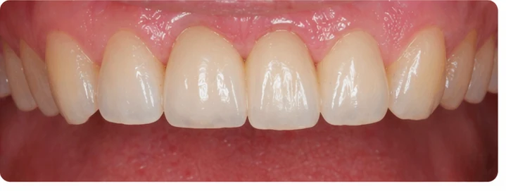 Bildverlauf Denticor – Schritt 8: provisorische Versorgung – oberer mittlerer, seitlicher Schneidezahn und Eckzahn