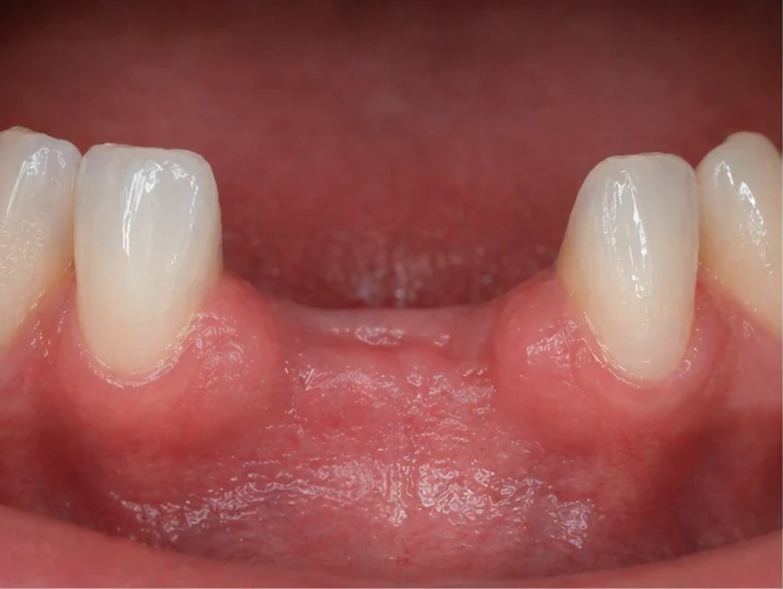 Bildverlauf Denticor – Schritt 1: provisorische Versorgung – zwei untere Frontzähne