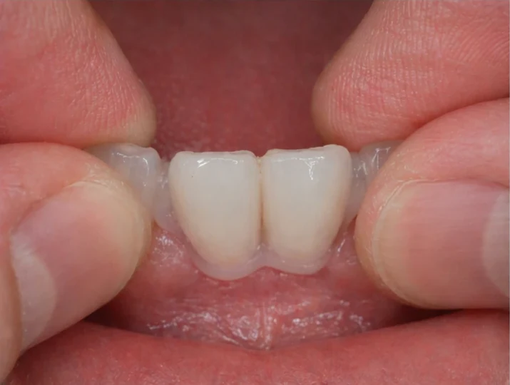 Bildverlauf Denticor – Schritt 3: provisorische Versorgung – zwei untere Frontzähne