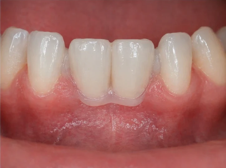 Bildverlauf Denticor – Schritt 4: provisorische Versorgung – zwei untere Frontzähne