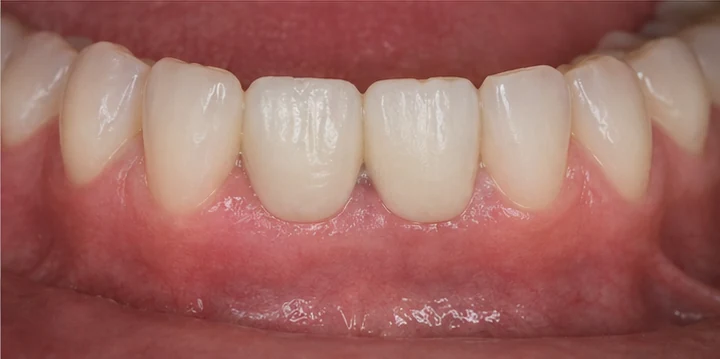 Bildverlauf Denticor – Schritt 6: provisorische Versorgung – unterer Backenzahn