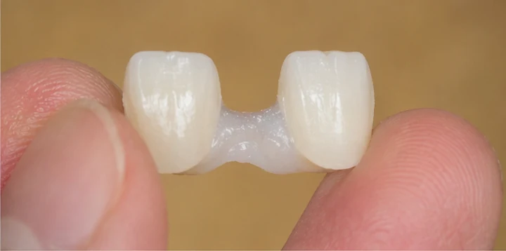 Bildverlauf Denticor – Schritt 6: provisorische Versorgung – zwei untere Frontzähne