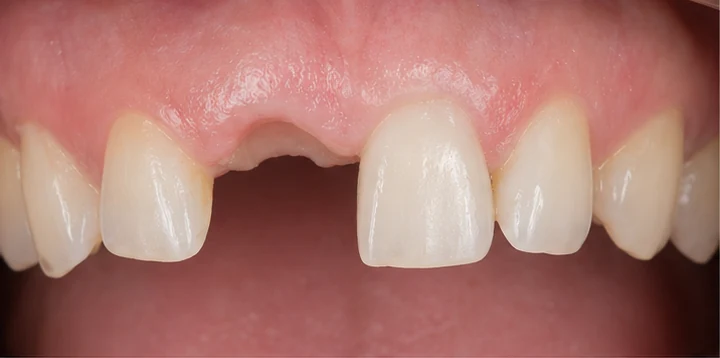 Bildverlauf Denticor — Schritt 1: provisorische Versorgung — unterer Prämolar