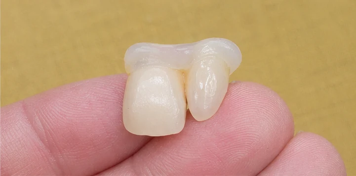 Bildverlauf Denticor — Schritt 2: provisorische Versorgung — unterer Prämolar