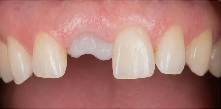 Bildverlauf Denticor — Schritt 3: provisorische Versorgung — unterer Prämolar