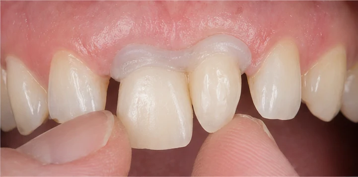Bildverlauf Denticor — Schritt 4: provisorische Versorgung — unterer Prämolar