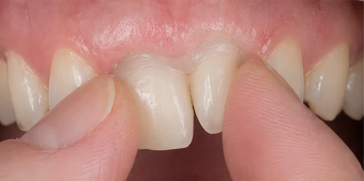 Bildverlauf Denticor — Schritt 5: provisorische Versorgung — unterer Prämolar