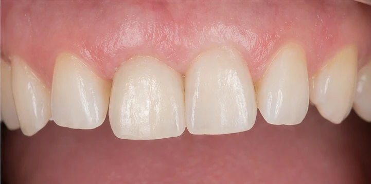 Bildverlauf Denticor — Schritt 6: provisorische Versorgung — unterer Prämolar