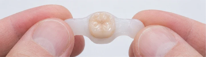 Bildverlauf Denticor – Schritt 7: provisorische Versorgung – unterer Schneidezahn und Eckzahn
