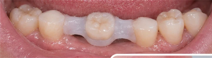 Bildverlauf Denticor – Schritt 8: provisorische Versorgung – unterer Schneidezahn und Eckzahn