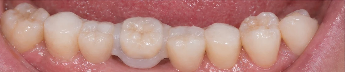 Bildverlauf Denticor – Schritt 9: provisorische Versorgung – unterer Schneidezahn und Eckzahn
