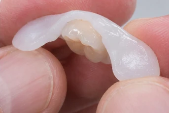 Bildverlauf Denticor – Schritt 10: provisorische Versorgung – unterer Schneidezahn und Eckzahn