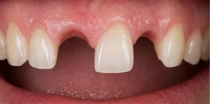 Bildverlauf Denticor – Schritt 1: provisorische Versorgung – zwei Lücken in einer Zahnreihe