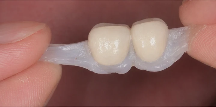 Bildverlauf Denticor – Schritt 3: provisorische Versorgung – ein oberer Backenzahn