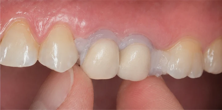 Bildverlauf Denticor – Schritt 4: provisorische Versorgung – ein oberer Backenzahn