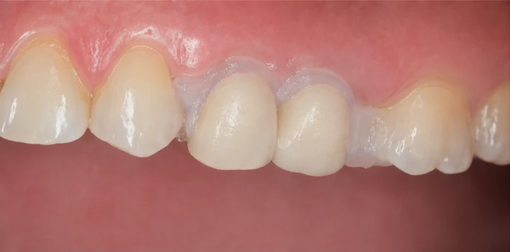 Bildverlauf Denticor – Schritt 5: provisorische Versorgung – ein oberer Backenzahn