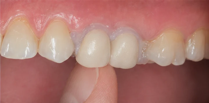 Bildverlauf Denticor – Schritt 6: provisorische Versorgung – ein oberer Backenzahn