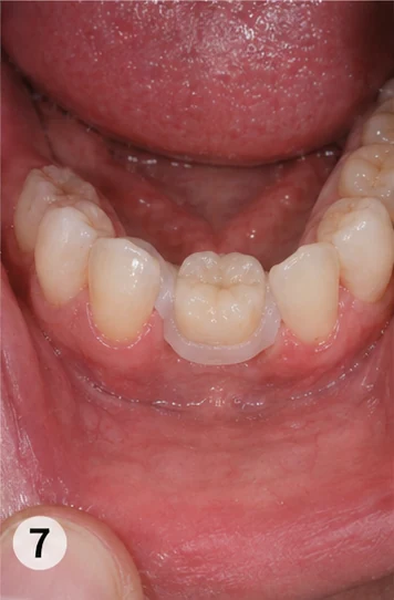 Bildverlauf Denticor – Schritt 7: provisorische Versorgung – ein oberer Backenzahn