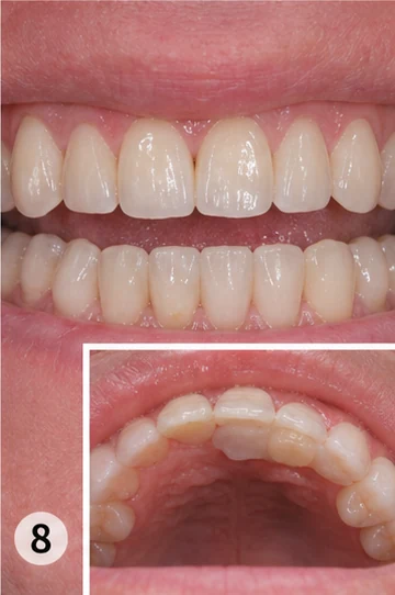 Bildverlauf Denticor – Schritt 8: provisorische Versorgung – ein oberer Backenzahn