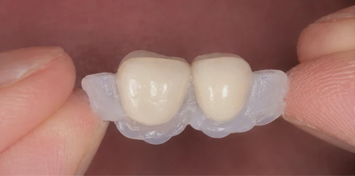 Bildverlauf Denticor – Schritt 1: provisorische Versorgung – zwei obere Frontzähne