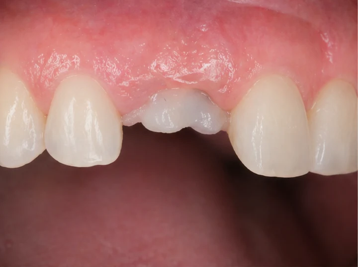 Bildverlauf Denticor – Schritt 1: provisorische Versorgung – oberer seitlicher Schneidezahn