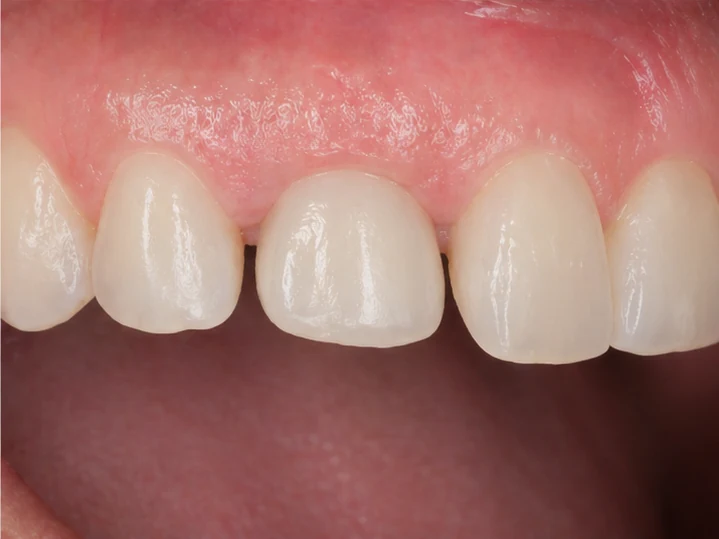Bildverlauf Denticor – Schritt 4: provisorische Versorgung – oberer seitlicher Schneidezahn