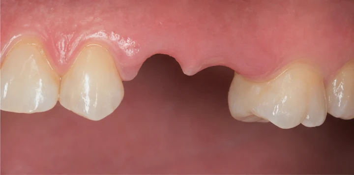 Bildverlauf Denticor – Schritt 2: provisorische Versorgung – oberer Eckzahn und Prämolar