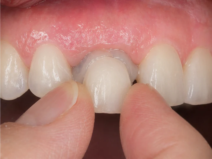 Bildverlauf Denticor – Schritt 2: provisorische Versorgung – ein oberer Eckzahn