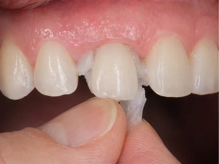 Bildverlauf Denticor – Schritt 3: provisorische Versorgung – ein oberer Eckzahn