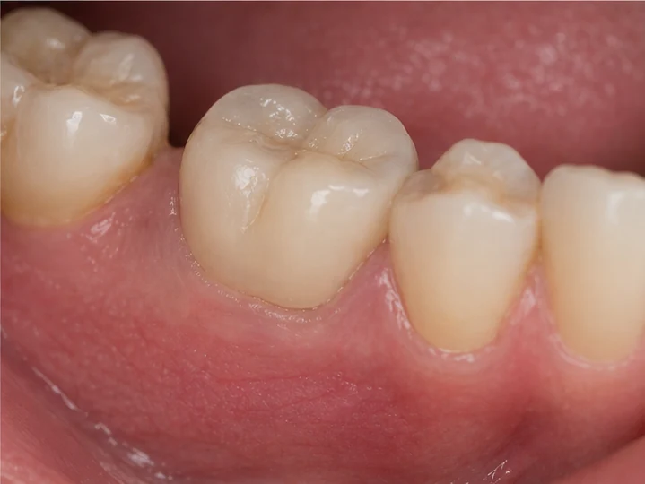Bildverlauf Denticor – Schritt 4: provisorische Versorgung – Lücken in beiden Kiefern