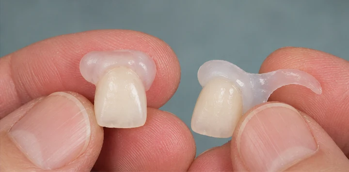 Bildverlauf Denticor – Schritt 2: provisorische Versorgung – drei Lücken in einer Zahnreihe