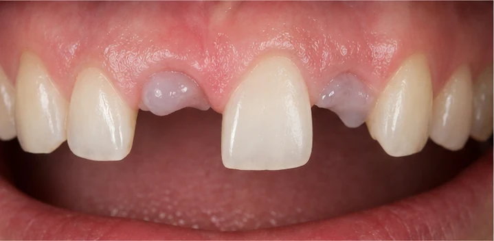 Bildverlauf Denticor – Schritt 3: provisorische Versorgung – drei Lücken in einer Zahnreihe