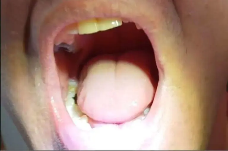 Kundin — Seitenzahn mit Denticor ergänzt