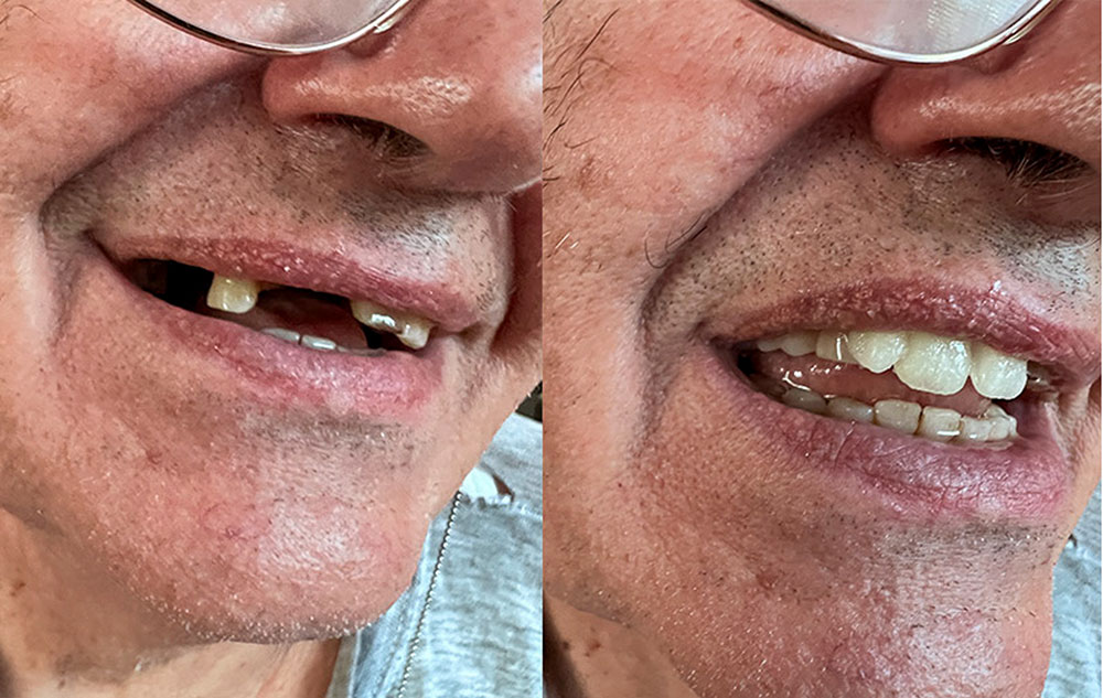 Kunde — mehrere fehlende Zähne vorher und nachher mit Denticor